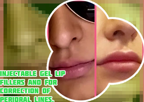 Best juvederm for lips