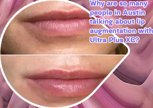 Best lip augmentation