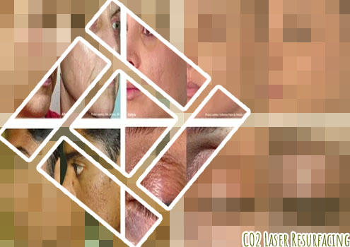 Co2 pixel laser resurfacing
