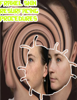 Fraxel laser resurfacing near me
