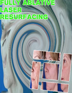 Laser resurfacing forehead