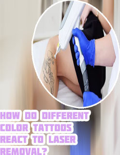 Tattoo removal experts