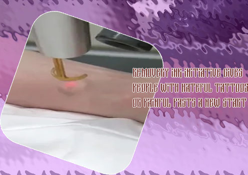 The finery tattoo removal
